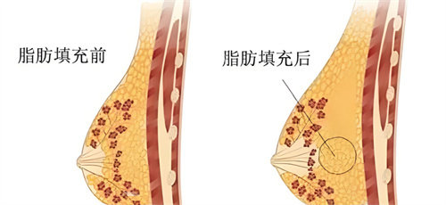 合肥维多利亚自体脂肪隆胸怎么样？医生1对1定制胸部曲线|自体脂肪存活率高