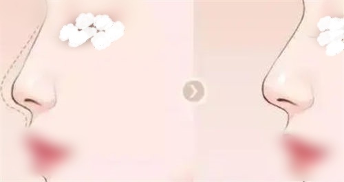 南宁密斯整形做鼻子怎么样?唐思欢医生做鼻子技术娴熟、美商高、费用不高、备受好评