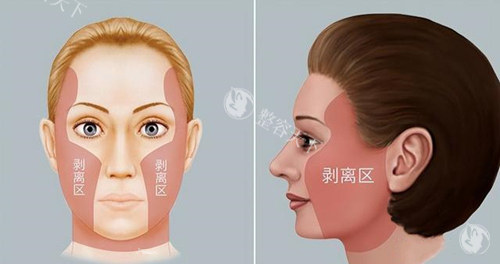 拉皮手术剥离区