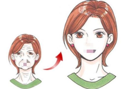 拉皮手术前后对比图