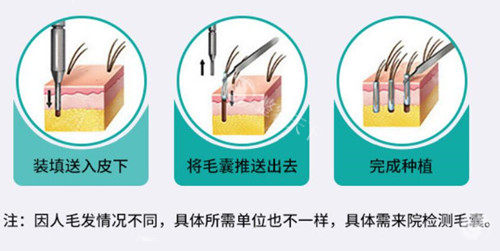 植发过程示意图片