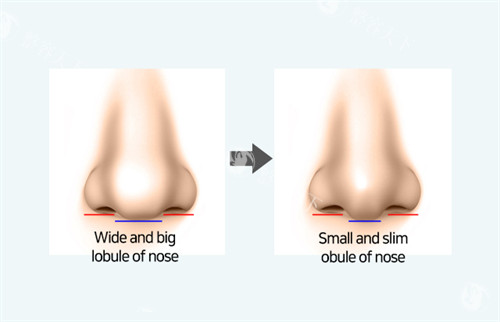 鼻翼缩小前后对比一览