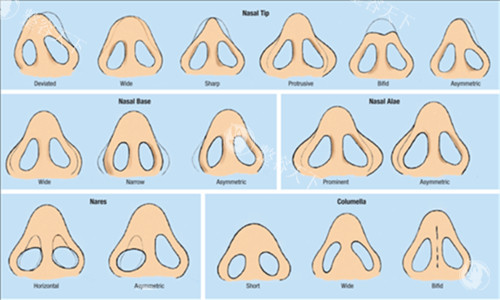 缩小鼻翼的对比图