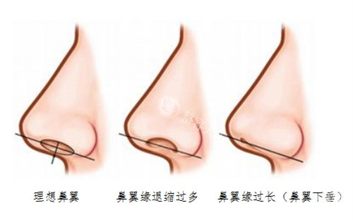 鼻翼退缩矫正术图片实例