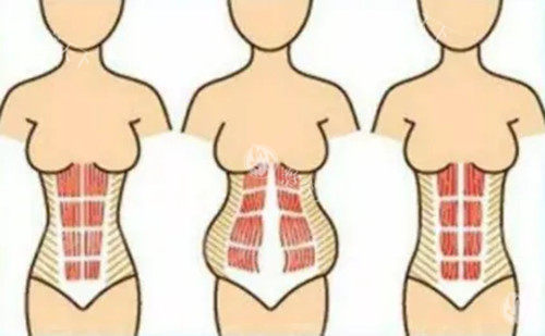 腹壁成形手术卡通示意图