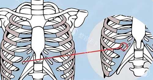 隆鼻肋骨鼻所用肋骨图