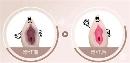 激光漂红一般做几次才有结果?分享三次治疗的真实体验!从结果初现到惊喜连连