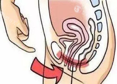 女性私密整形位置示意图