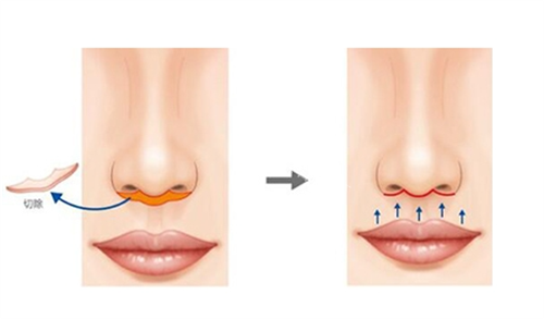 卢九宁医生口碑怎么样？卢九宁医生患者真实评价不错，做人中缩短术比较好