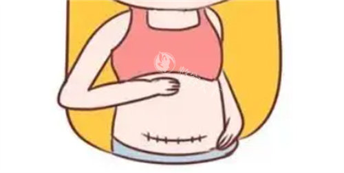 腹部疤痕