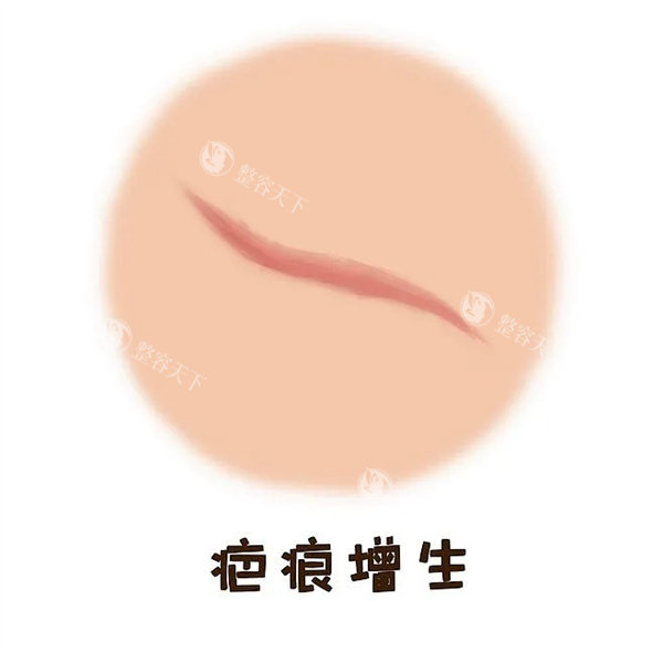 疤痕增生图片