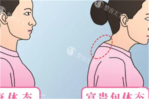 富贵包的体态图解