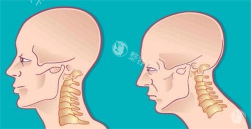 脖子长出富贵包卡通照片图