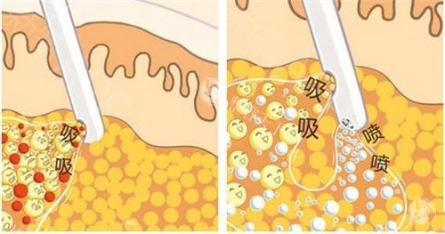 抽脂手术抽脂方式动画演示图