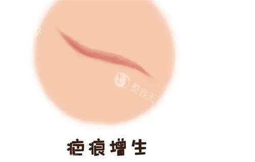 疤痕增生图示