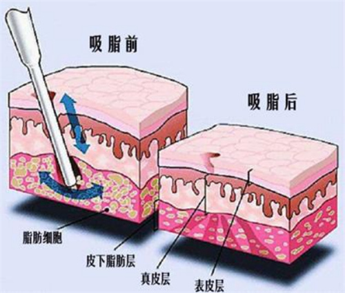 王仁根医生吸脂做的咋样？解析其优质吸脂技术与独特手术风格是吸脂有名的医生