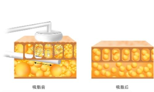 上海华美整形何斌医师简介：擅长吸脂溶脂_分层塑形_支持在线预约...