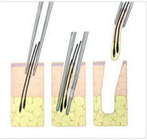 提取毛囊动画图