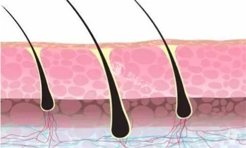 植发的毛囊