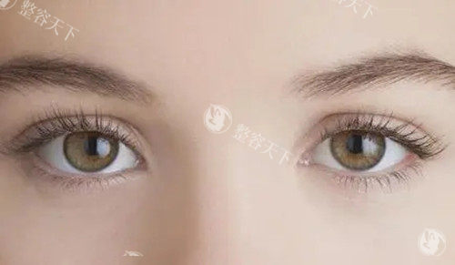 开眼角手术.webp