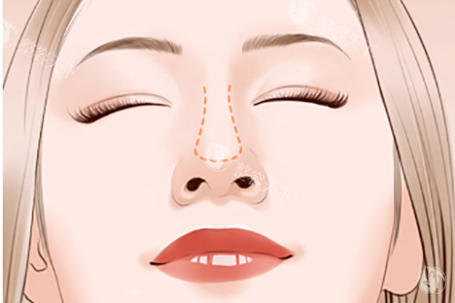 隆鼻鼻梁位置示意图