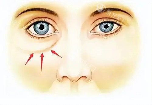 太原美诗沁医美怎么样，祛眼袋技术十分出色备受顾客好评！