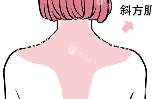 背部吸脂卡通示意图
