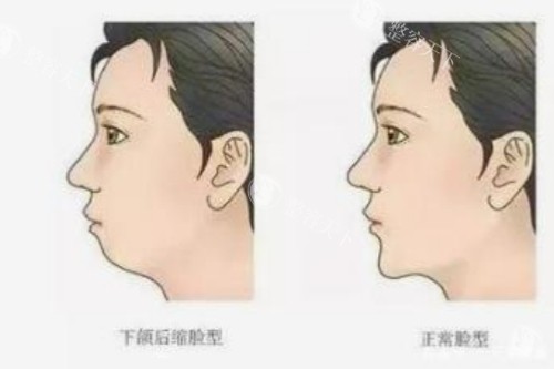 正常脸型和下巴后缩脸型对比图
