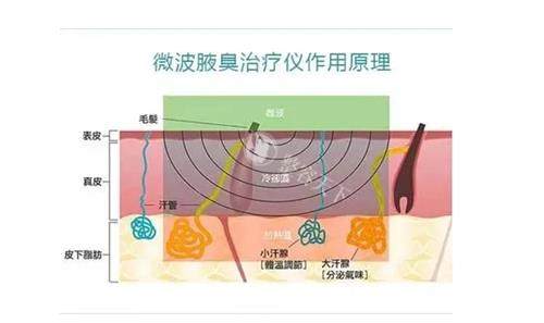 miradry微波治疗原理