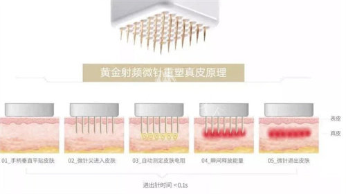 美迪迈黄金微针多少钱一次？3500左右起步！功效作用、适用范围也分享给你