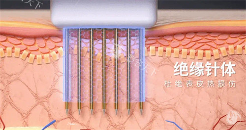 黄金微针针头图解