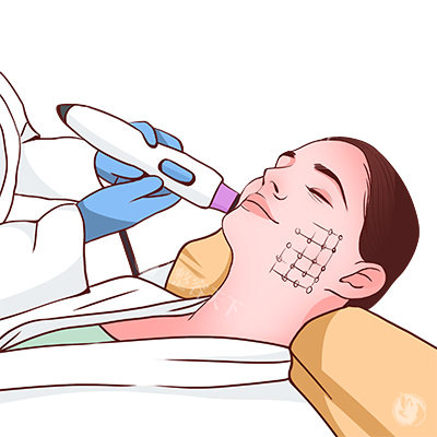 黄金微针操作图