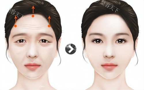 沈阳百嘉丽刘海滨提眉术怎么样？切口隐蔽，可改善眉下垂与上睑松弛