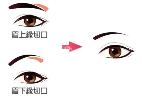 提眉的不同切口参考