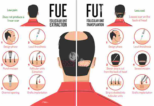 FUE和FUT对比图