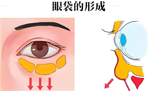上海美诗沁医疗美容祛眼袋好吗？技术牛价格透明，网友亲测超靠谱！