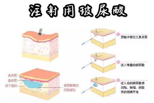 伊塑柔玻尿酸属于什么档次？注射哪些部位好？注射太阳穴|苹果肌|鼻唇沟成效好