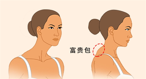 温州徐淑卿医生做富贵包手术好，配合术后管理不易复发，患者反馈良好