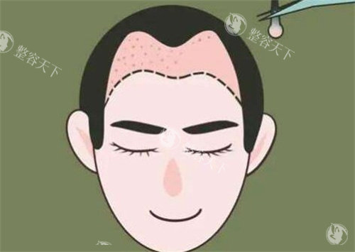 毕节发博士植发M型发际线种植