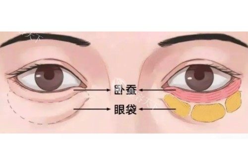 眼袋、卧蚕区分图
