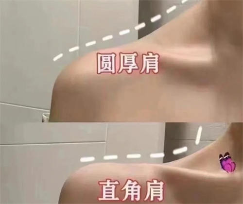 激光溶脂瘦肩膀能保持多久？会不会反弹？一次性说清楚