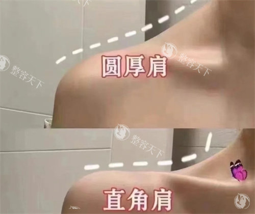 圆肩膀和直角肩对比