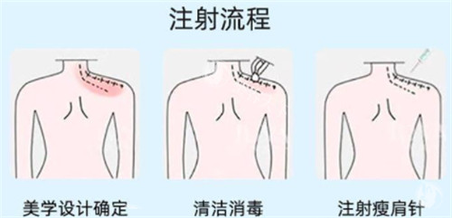 瘦肩注射点位图