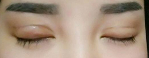 肉条感像毛毛虫？显微剥离技术让我的双眼皮从 “香肠眼” 变自然妈生款