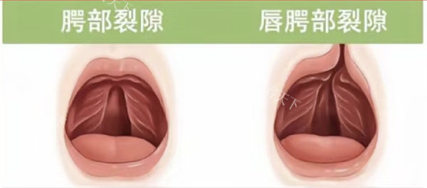 唇腭裂
