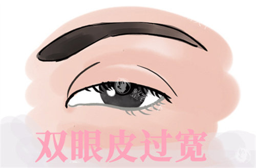 双眼皮过宽修复