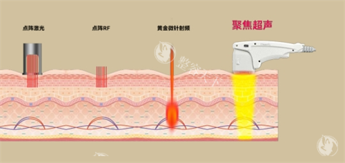 尖峰超声王作用皮肤层次透视图