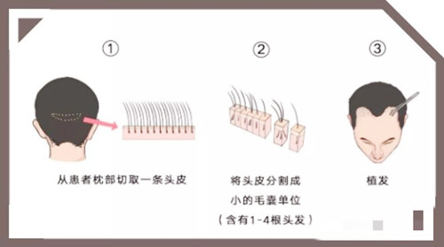 天生发际线高植发需要多少钱？1000/2000/3000单位发际线植发价格