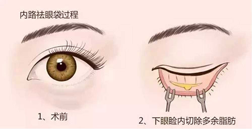 北京轻美颜医疗美容怎么样？眼袋提升技术可靠，上百病例实证，北京祛眼袋必选机构之一