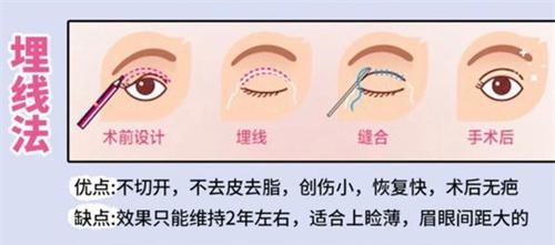 谭敏峰双眼皮医院正规吗？正规！面诊0元且无隐形消费
